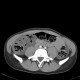 Colitis, acute colitis of the right colon, cecum and ascendens: CT - Computed tomography